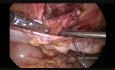 Reparación laparoscópica de la hernia de Spiegel