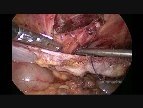 Reparación laparoscópica de la hernia de Spiegel