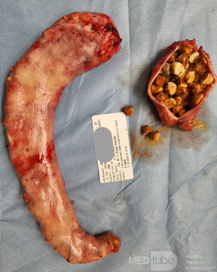 Después de la cirugía de gastrectomía en manga y colecistectomía, la parte del estómago eliminada y los cálculos biliares