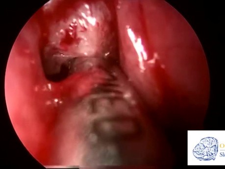 Sinusitis fúngica alérgica - Cirugía