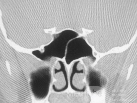 Mucocele del seno esfenoidal resuelto espontáneamente