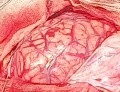 Craniectomía descompresiva en infarto maligno de la arteria cerebral media
