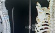 Abordaje Anterior de Cloward para Fractura Cervical AO Spine Tipo C con Síndrome de Brown Sequard