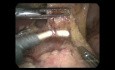 Gastrectomía subtotal distal laparoscópica para el cáncer gástrico