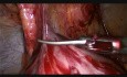 Reversión laparoscópica de procedimiento de Hartmann