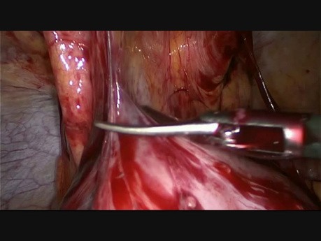 Reversión laparoscópica de procedimiento de Hartmann