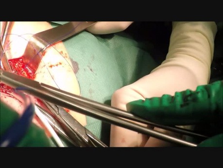 Reparación de hernia umbilical con malla sintética