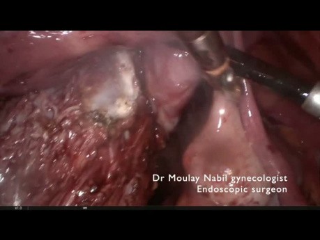 Miomectomía ístmico-cervical en abdomen con cicatrices