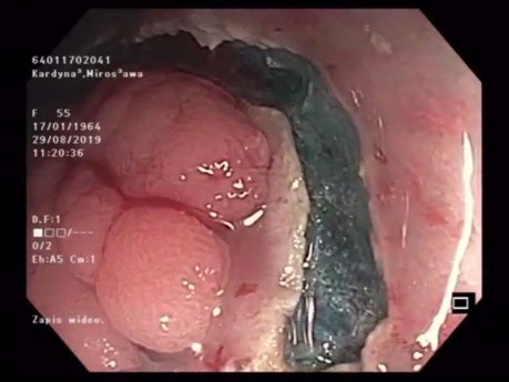 Disección submucosa endoscópica (DSE) / resección mucosa endoscópica (REM) híbrida