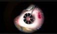 Implantación parcial de iris con extracción de catarata en el ojo con aniridia congénita, catarata, miopía alta y nistagmo