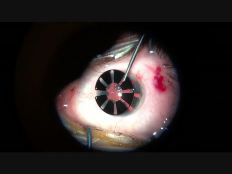 Implantación parcial de iris con extracción de catarata en el ojo con aniridia congénita, catarata, miopía alta y nistagmo