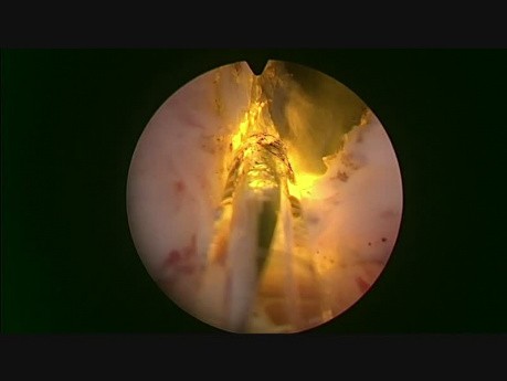 GreenLEP - Greenlight Enucleation of the Prostate