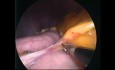 Procedimiento SASI: bipartición en asa con gastrectomía en manga para diabetes tipo 2