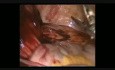 Tratamiento laparoscópico de un gran gosipiboma complicado con penetración de la pared intestinal