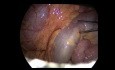 Resección del muñón con anastomosis yeyuno-yeyunal