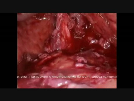 Colecistectomía laparoscópica en paciente con cálculos biliares y cirrosis hepática