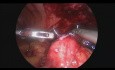 Escisión laparoscópica de la fístula ceacocutánea (post apendicectomía)