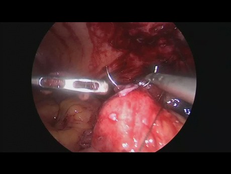 Escisión laparoscópica de la fístula ceacocutánea (post apendicectomía)