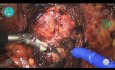 Prostatectomy with Versius – M. De Dominicis