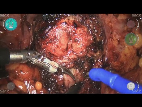 Prostatectomy with Versius – M. De Dominicis