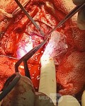 Planificación quirúrgica con neuronavegador en paciente con lesión de masa intracraneal. Glioma de alto grado.