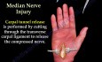 Síndrome del túnel cubital y lesiones nerviosas - video didáctico