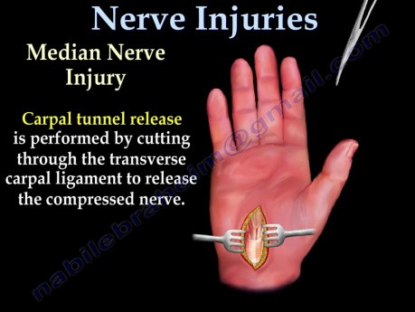 Síndrome del túnel cubital y lesiones nerviosas - video didáctico