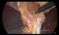 Reparación laparoscópica de la hernia ventral encarcelada