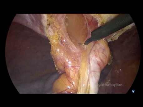 Reparación laparoscópica de la hernia ventral encarcelada