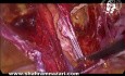 Reparación laparoscópica de hernia inguinal recurrente después de un abordaje abierto previo