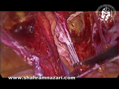 Reparación laparoscópica de hernia inguinal recurrente después de un abordaje abierto previo