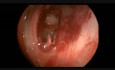 Pólipo esfenocoanal / Cornete nasal supremo / Pulsación carotídea interna