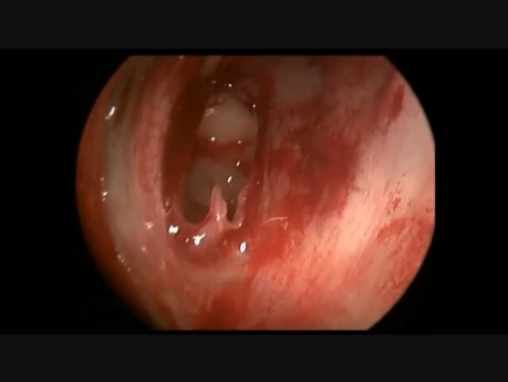 Pólipo esfenocoanal / Cornete nasal supremo / Pulsación carotídea interna