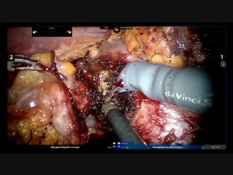 Enucleación robótica de tumores renales múltiples con control vascular selectivo de las ramas arteriales renales 