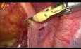 Resección anterior alta laparoscópica y resección hepática en cuña