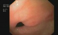 Sangrado del tracto gastrointestinal superior en una colonoscopia