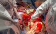 Extrapleural Techniques for Lung Procurement in Patients with Frozen Mediastinum