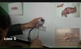 Reimplantación - caso 2