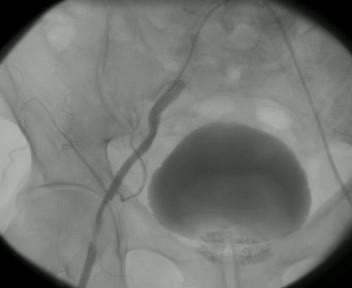 Arteria femoral aterosclerótica