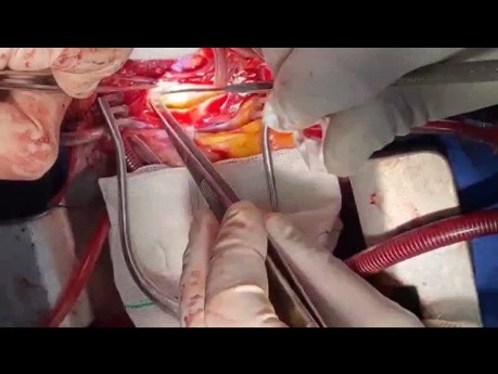 Endarterectomía de arteria pulmonar en paciente con HPTEC