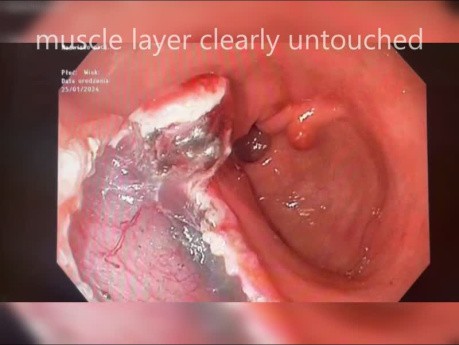 Lesión antral Disección submucosa endoscópica (DES)