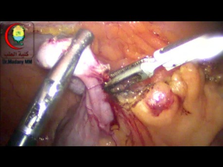 Apendicitis crónica