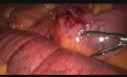 Obstrucción intestinal con banda fibrosa