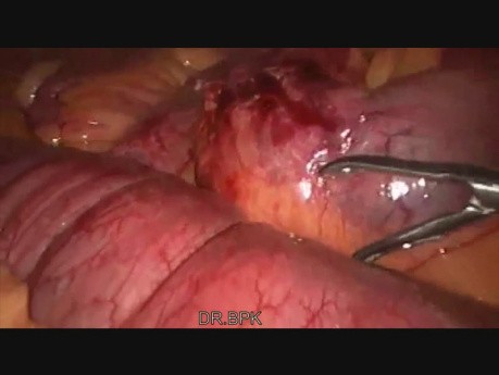 Obstrucción intestinal con banda fibrosa