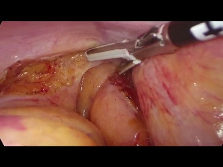 TaTME (escisión total del mesorrecto transanal) para cáncer rectal bajo 