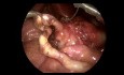Procedimiento laparoscópico de Ladd en un neonato con malrotación del intestino medio