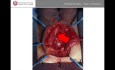 Estenosis uretral