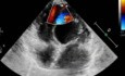 Una pequeña (restrictiva) comunicación interventricular CIV-ecocardiografía