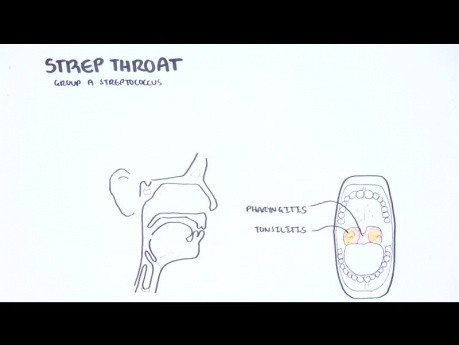 Amigdalitis aguda - causas (viral, bacteriana), fisiopatología, tratamiento, amigdalectomía