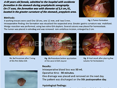 Resección laparoscópica en cuña de tumor del estroma gastrointestinal  (GIST)